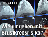 Bildschirmdarstellung einer Magnetresonanz-Mammographie