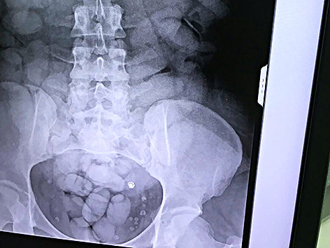 © APA/AFP/Royal Thai Police Röntgenbild der Drogenschmugglerin zeigt etliche Päckchen